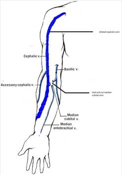 Prophylactic Ligation of the Median Cubital Vein to Improve the Patency
